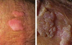 hpv bumps removal