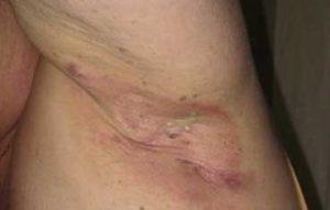 Hidradenitis Suppurativa Symptoms: Itchy Lumps, Pus on Armpits