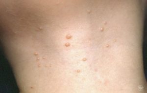 skin molluscum contagiosum athletes dermatologists preventative stay care tips game treatment dermatology newswise line