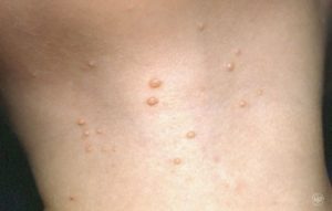 https://farberdermatology.com/wp-content/uploads/2019/01/Molluscum-contagiosum-image-300x191.jpg