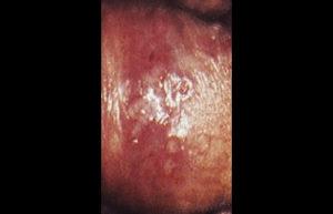 Pictures of Herpes Sores