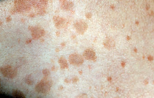 Tinea Ringworm