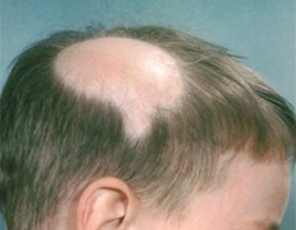 Alopecia Areata