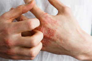 Eczema Treatment