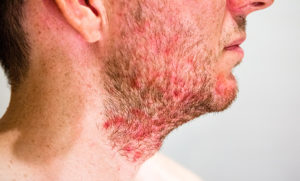 Folliculitis Treatment