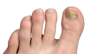 Ingrown Toenail Treatment