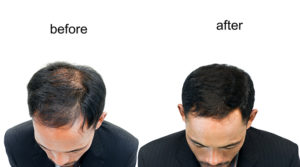 Hair Loss Treatment