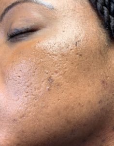 Acne Scarring
