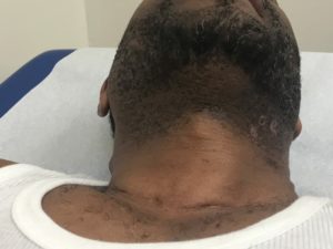 ingrown hair cyst neck