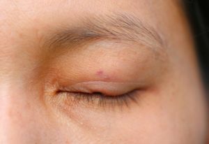 Eyelid Spots
