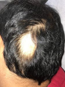 Alopecia Areata Treatment Specialist in Philadelphia & Main Line Pa- farber  dermatology