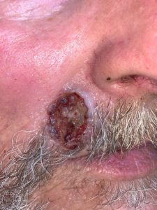 basal cell carcinoma Philadelphia and Philadelphia Mainline Pa