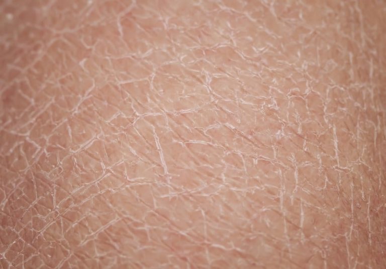 Dry Skin Treatment- Philadelphia PA & Main Line PA