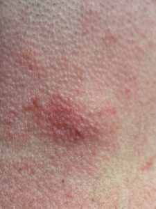 keratosis on arms