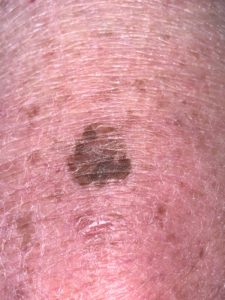 melanoma