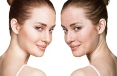 pore treatment reduction