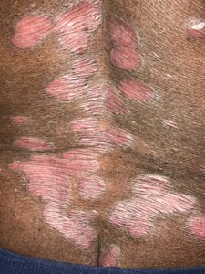 psoriasis