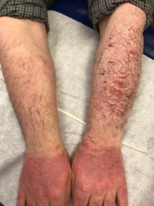 psoriasis