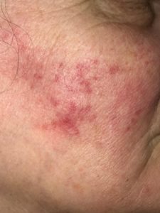 rosacea cheeks treatment