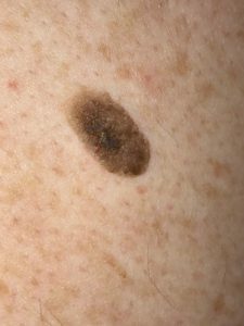 seborrheic keratosis