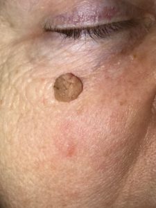 seborrheic keratosis - face