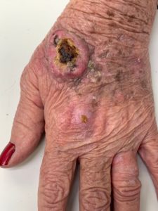 squamous cell carcinoma