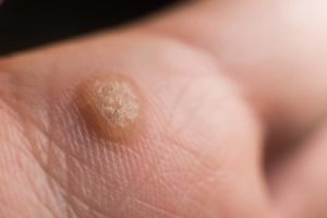 warts treatment by