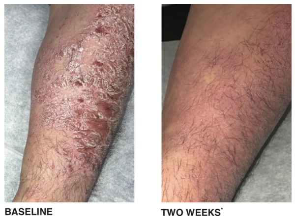 Psoriasis