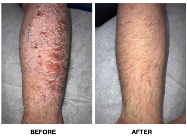 psoriasis after surgery