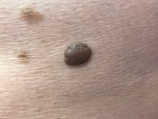 Seborrheic Keratosis