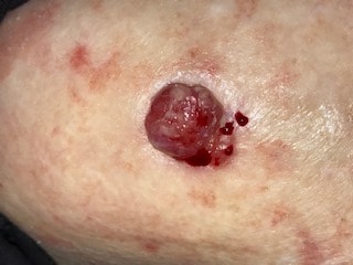 Skin Cancer treatment