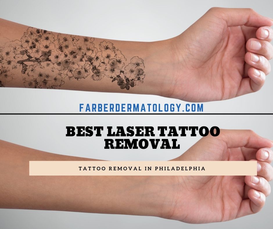 Laser Tattoo Removal- Phildelphia & Main Line PA - farber dermatology