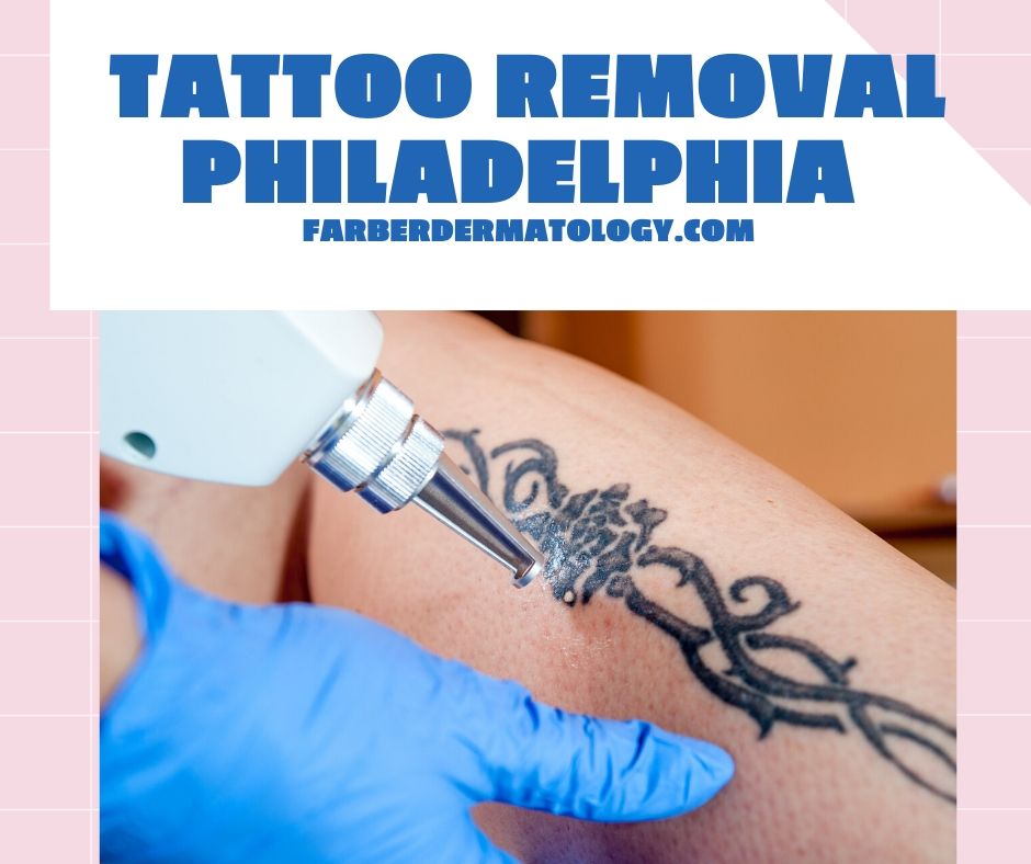 Tattoo removal progress : r/TattooRemoval
